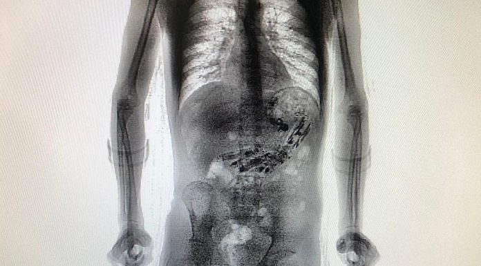 imagem de um scanner corporal mostrando o homem em pé com linhas dos aparelhos dentro do estômago