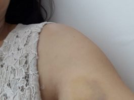 close em hematoma no braço esquerdo da mulher